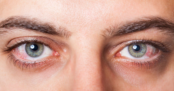 5 consejos para reducir la sequedad de tus ojos